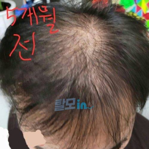 핀페시아 300정 photo review